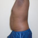 ULF Before & After Patient #1177