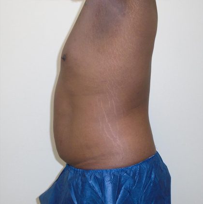ULF Before & After Patient #1177