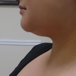 Chin Before & After Patient #1145