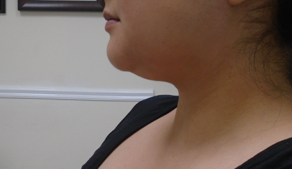 Chin Before & After Patient #1145