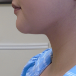 Chin Before & After Patient #1145