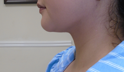 Chin Before & After Patient #1145