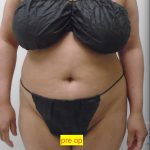 Lipo 360 Before & After Patient #1183