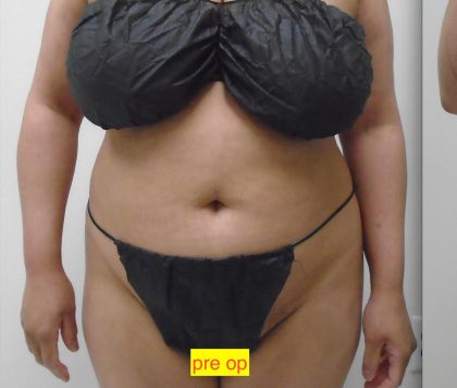 Lipo 360 Before & After Patient #1183