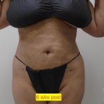 Lipo 360 Before & After Patient #1183