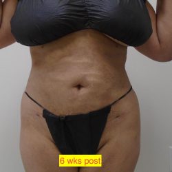 Lipo 360 Before & After Patient #1183