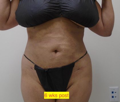 Lipo 360 Before & After Patient #1183