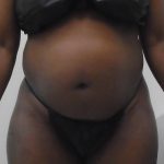 Lipo 360 Before & After Patient #1206