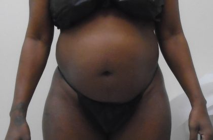 Lipo 360 Before & After Patient #1206