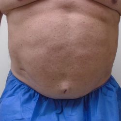 ULF Before & After Patient #1186