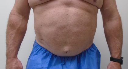 ULF Before & After Patient #1186