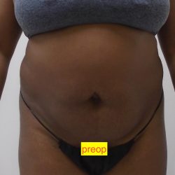 Lipo 360 Before & After Patient #1205