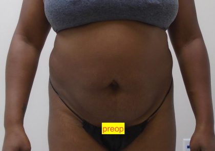 Lipo 360 Before & After Patient #1205