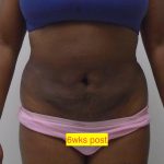 Lipo 360 Before & After Patient #1205
