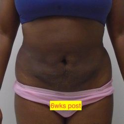 Lipo 360 Before & After Patient #1205