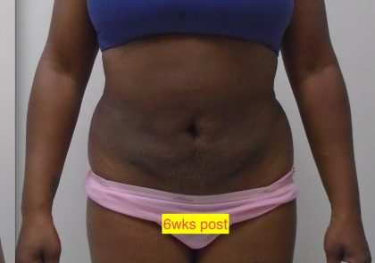 Lipo 360 Before & After Patient #1205