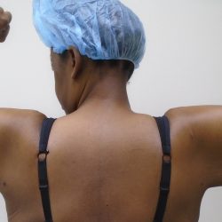 Arm Liposuction Before & After Patient #1199