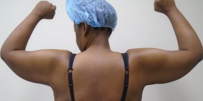Arm Liposuction Before & After Patient #1199