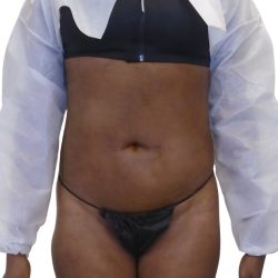Lipo 360 Before & After Patient #1192