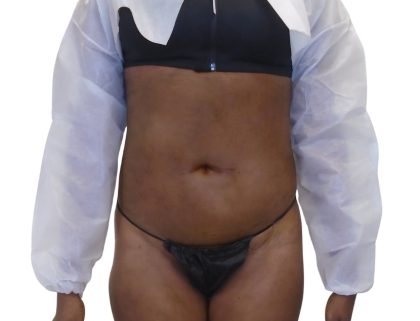 Lipo 360 Before & After Patient #1192