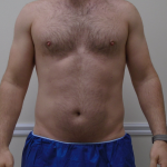 ULF Before & After Patient #1222