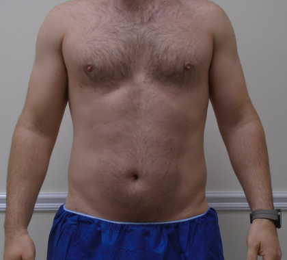 ULF Before & After Patient #1222