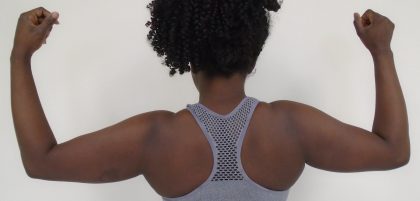 Arm Liposuction Before & After Patient #1202