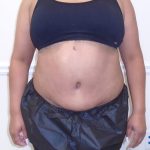 Lipo 360 Before & After Patient #1217