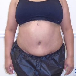 Lipo 360 Before & After Patient #1217