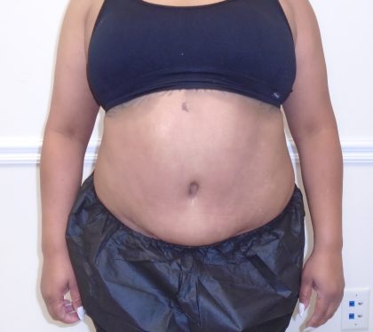 Lipo 360 Before & After Patient #1217