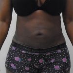 Lipo 360 Before & After Patient #1206