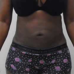 Lipo 360 Before & After Patient #1206