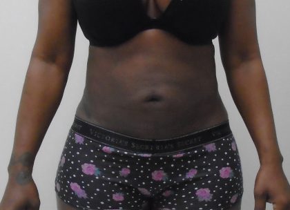 Lipo 360 Before & After Patient #1206