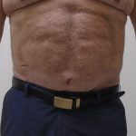ULF Before & After Patient #1186