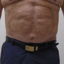 ULF Before & After Patient #1186