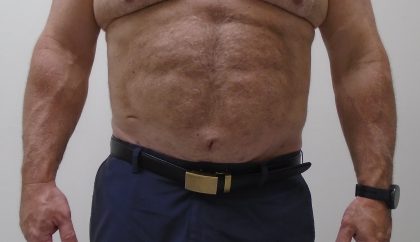 ULF Before & After Patient #1186