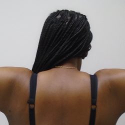 Arm Liposuction Before & After Patient #1199