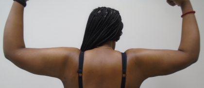 Arm Liposuction Before & After Patient #1199
