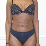Lipo 360 Before & After Patient #1192
