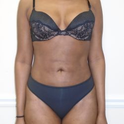Lipo 360 Before & After Patient #1192