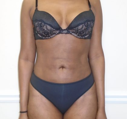 Lipo 360 Before & After Patient #1192