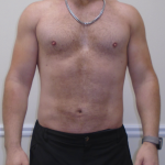 ULF Before & After Patient #1222