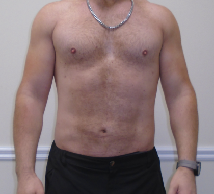 ULF Before & After Patient #1222