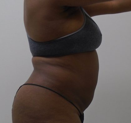 Lipo 360 Before & After Patient #1205