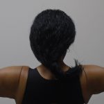 Arm Liposuction Before & After Patient #1189