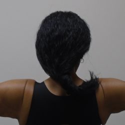 Arm Liposuction Before & After Patient #1189