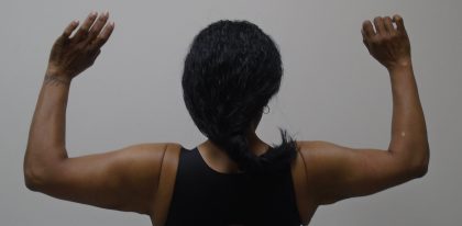 Arm Liposuction Before & After Patient #1189