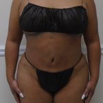 Lipo 360 Before & After Patient #1217