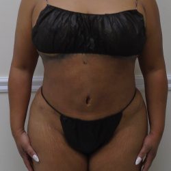 Lipo 360 Before & After Patient #1217