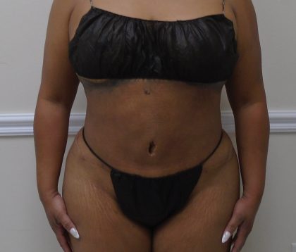 Lipo 360 Before & After Patient #1217